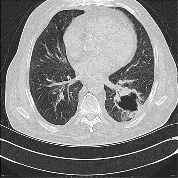 File:Cavitating left lower lobe lesion - squamous cell lung cancer (Radiopaedia 27749-28176 Axial lung window 31).jpg