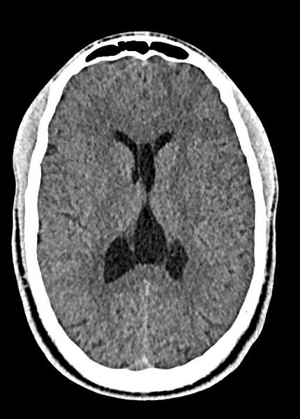 File:Cavum septum pellucidum and cavum vergae (Radiopaedia 77797-90060 Axial Brain Window 59).jpg