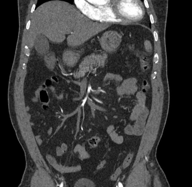 File:Celiac artery dissection (Radiopaedia 52194-58080 C 11).jpg