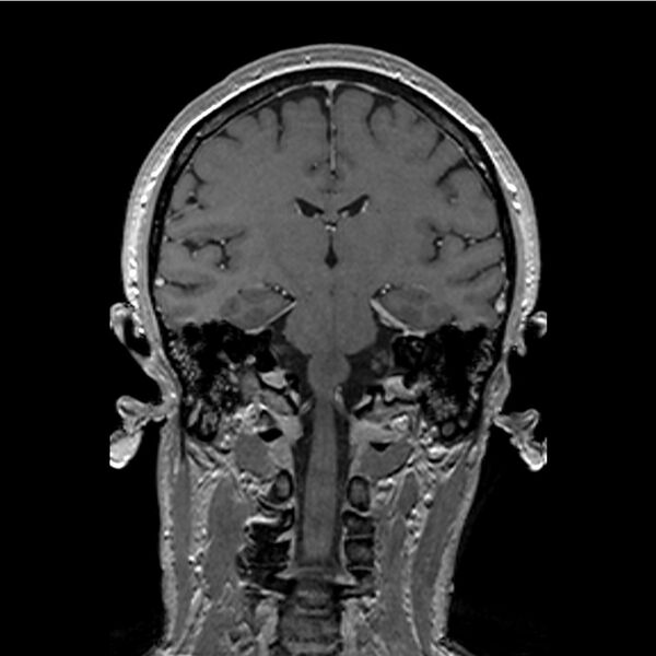 File:Central base of skull meningioma (Radiopaedia 53531-59549 Coronal T1 C+ 28).jpg
