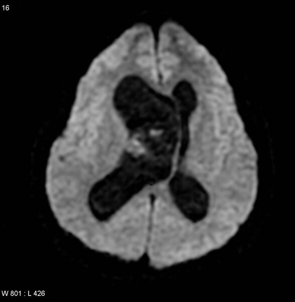 File:Central neurocytoma (Radiopaedia 4355-6613 Axial DWI 1).jpg