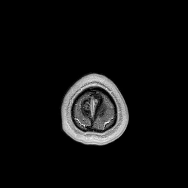 File:Central neurocytoma (Radiopaedia 79320-92380 Axial T1 C+ 225).jpg