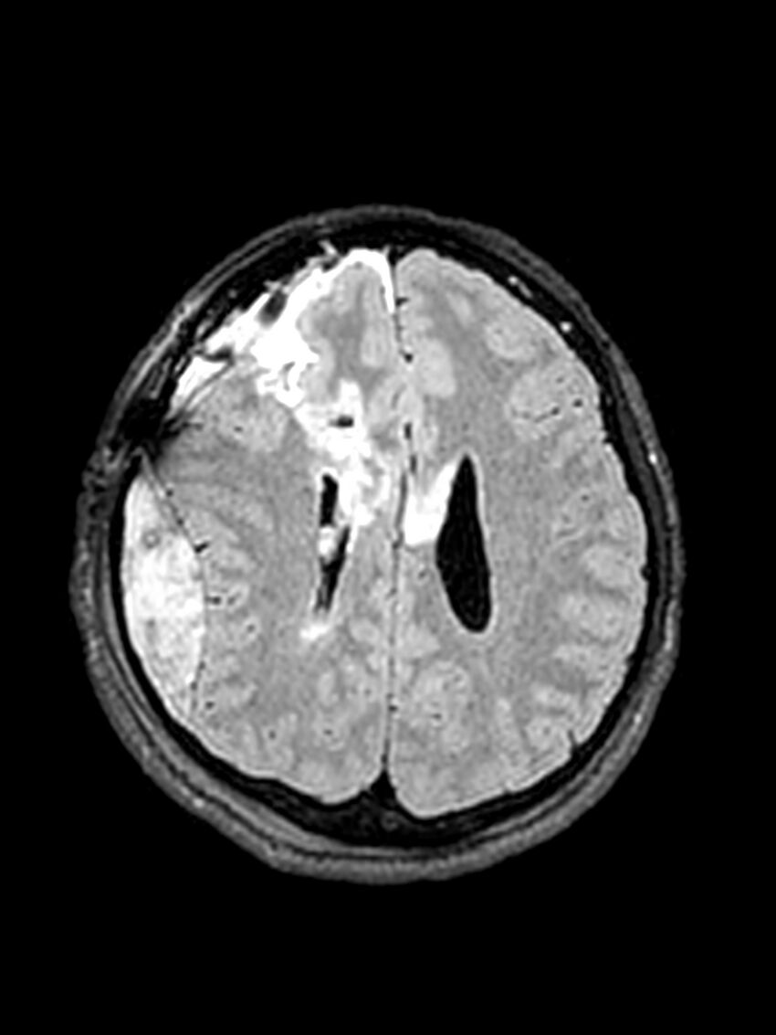 Central neurocytoma (Radiopaedia 79320-92381 Axial FLAIR 63).jpg