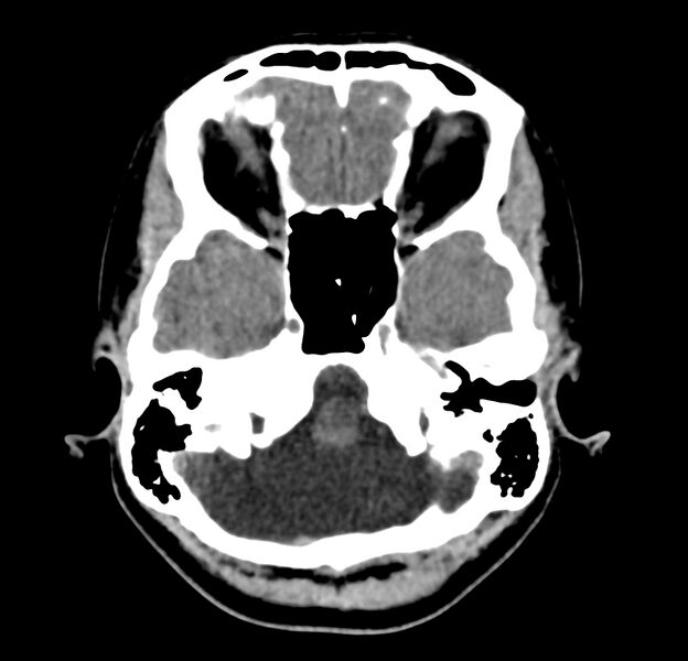File:Cerebellar agenesis (Radiopaedia 30203-30817 Axial non-contrast 8).jpg