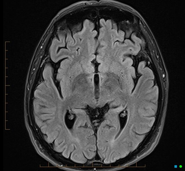 File:Cerebellar gangliocytoma (Radiopaedia 65377-74422 Axial FLAIR 18).jpg