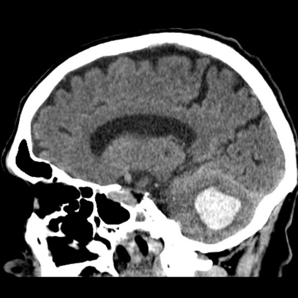 File:Cerebellar hemorrhage (Radiopaedia 27193-27359 C 27).jpg