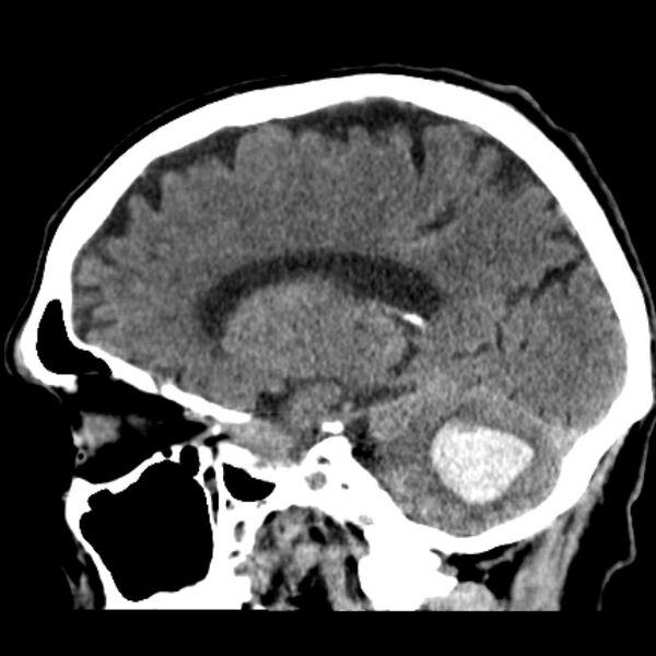 File:Cerebellar hemorrhage (Radiopaedia 27193-27359 C 28).jpg