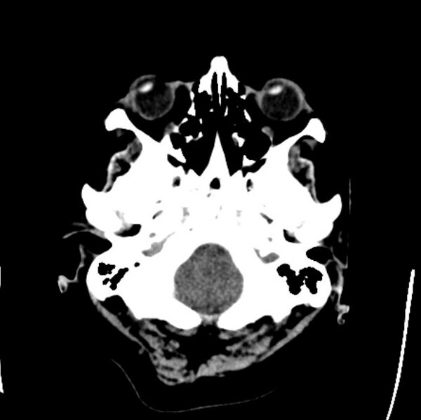 File:Cerebellar hemorrhage causing obstructive hydrocephalus (Radiopaedia 33989-35207 Axial non-contrast 6).jpg