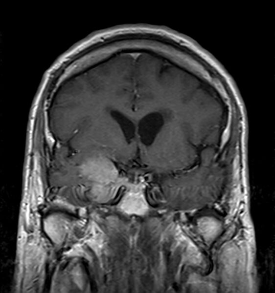 File:Cerebellopontine angle meningioma (Radiopaedia 24459-24764 Coronal T1 C+ 8).jpg