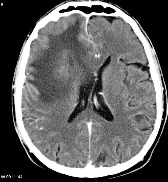 File:Cerebral abscesses secondary to contusions (Radiopaedia 5201-6967 Axial C+ delayed 2).jpg