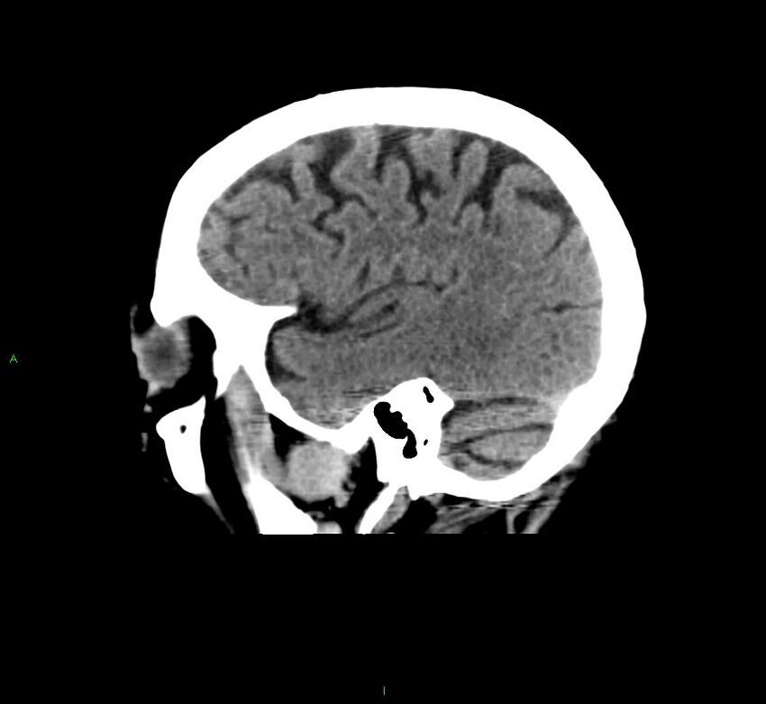 Cerebral amyloid angiopathy-associated lobar intracerebral hemorrhage (Radiopaedia 58376-65511 C 13).jpg