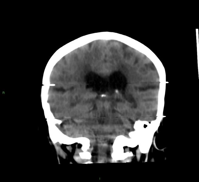 File:Cerebral amyloid angiopathy-associated lobar intracerebral hemorrhage (Radiopaedia 58377-65514 Coronal non-contrast 27).jpg