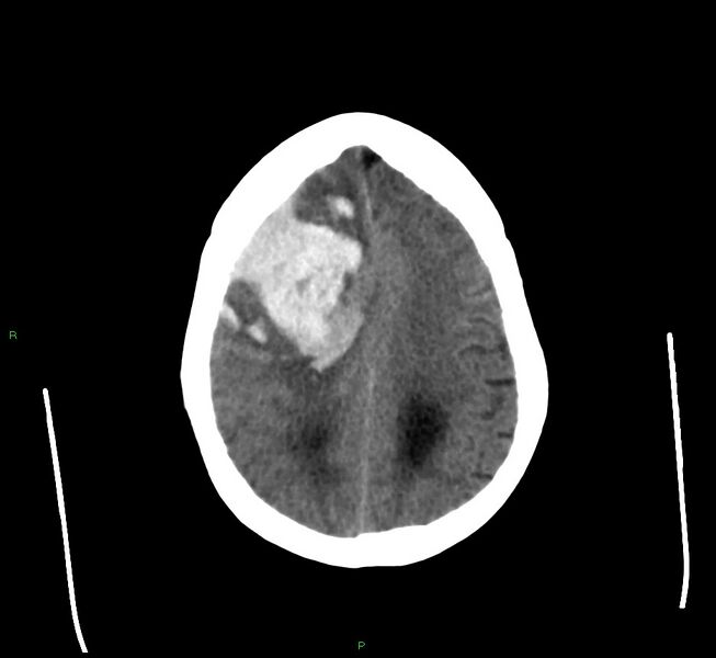 File:Cerebral amyloid angiopathy-associated lobar intracerebral hemorrhage (Radiopaedia 58560-65723 Axial non-contrast 15).jpg