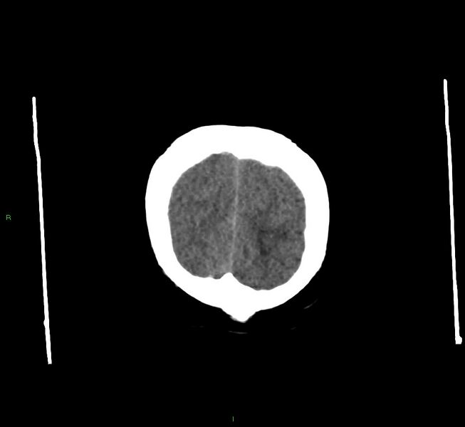 File:Cerebral amyloid angiopathy-associated lobar intracerebral hemorrhage (Radiopaedia 58560-65723 Coronal non-contrast 9).jpg