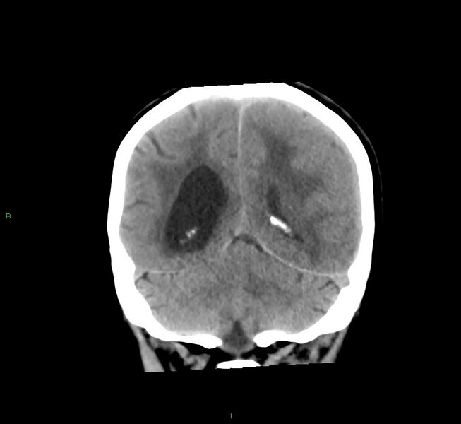 File:Cerebral amyloid angiopathy-associated lobar intracerebral hemorrhage (Radiopaedia 58561-65724 Coronal non-contrast 21).jpg