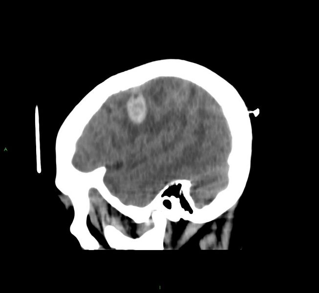 File:Cerebral amyloid angiopathy-associated lobar intracerebral hemorrhage (Radiopaedia 58566-65730 C 10).jpg