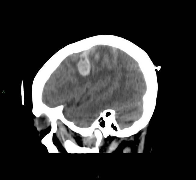 File:Cerebral amyloid angiopathy-associated lobar intracerebral hemorrhage (Radiopaedia 58566-65730 C 11).jpg