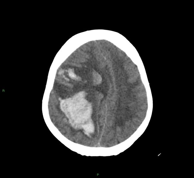 File:Cerebral amyloid angiopathy-associated lobar intracerebral hemorrhage (Radiopaedia 58751-65972 Axial non-contrast 18).jpg