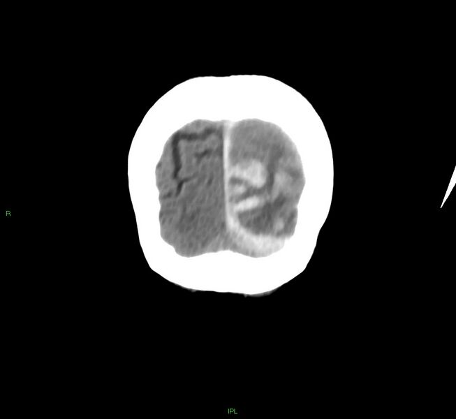 File:Cerebral amyloid angiopathy-associated lobar intracerebral hemorrhage (Radiopaedia 58754-65975 Coronal non-contrast 9).jpg