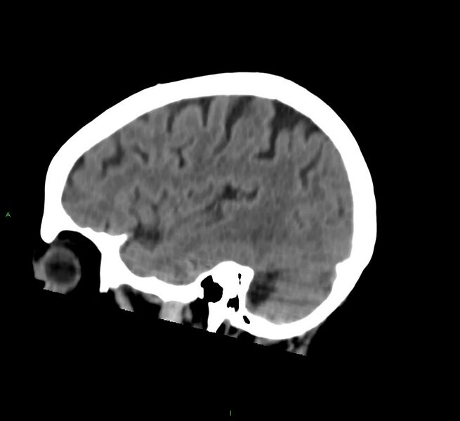 File:Cerebral amyloid angiopathy-associated lobar intracerebral hemorrhage (Radiopaedia 58757-65978 C 15).jpg