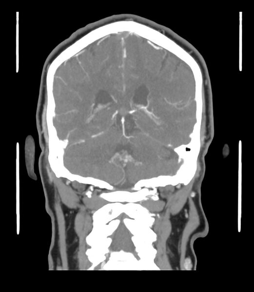 File:Cerebral dural venous sinus thrombosis (Radiopaedia 86514-102576 B 49).jpg
