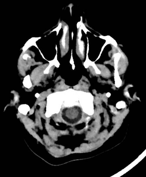 File:Cerebral edema due to severe hyponatremia (Radiopaedia 89826-106937 Axial non-contrast 4).jpg