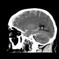 Cerebral hemorrhagic contusions (Radiopaedia 23145-23188 C 29).jpg