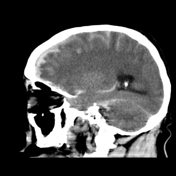 File:Cerebral hemorrhagic contusions (Radiopaedia 23145-23188 C 29).jpg