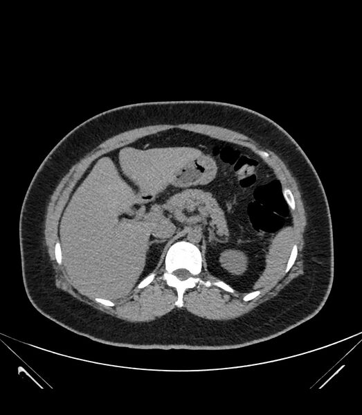 File:Cervical aortic arch with coarctation and aneurysms (Radiopaedia 44035-47552 Axial non-contrast 48).jpg