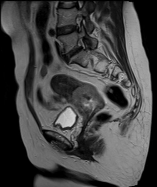 File:Cervical carcinoma (Radiopaedia 88312-104943 Sagittal T2 18).jpg