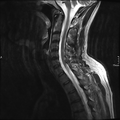 Cervical dural CSF leak on MRI and CT treated by blood patch (Radiopaedia 49748-54995 Sagittal T2 5).png