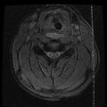 Cervical flexion teardrop fracture with cord hemorrhage (Radiopaedia 32497-33455 Axial Gradient Echo 12).jpg