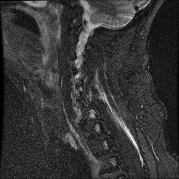 File:Cervical fracture and dislocation with locked facet (Radiopaedia 31837-32781 Sagittal STIR 13).jpg