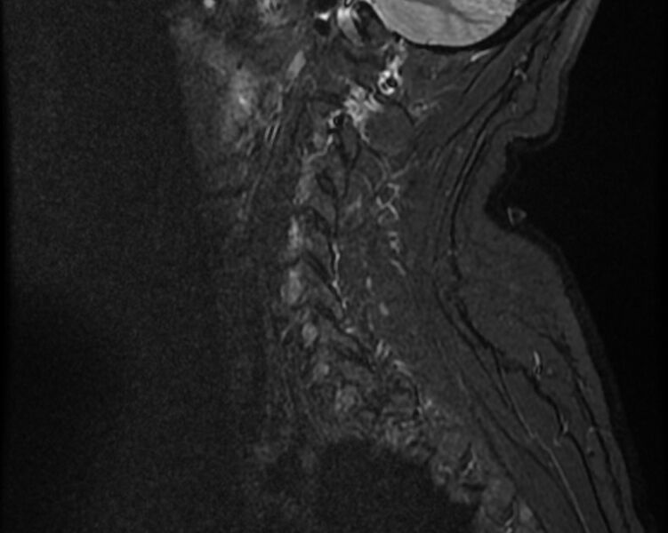 File:Cervical schwannoma (Radiopaedia 72399-82934 Sagittal STIR 3).jpg