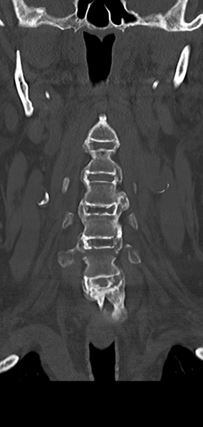 File:Cervical spine fracture - chalk stick (Radiopaedia 39116-41323 Coronal bone window 15).png
