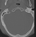 Cervical spondylolysis (Radiopaedia 49616-54811 Axial bone window 4).png