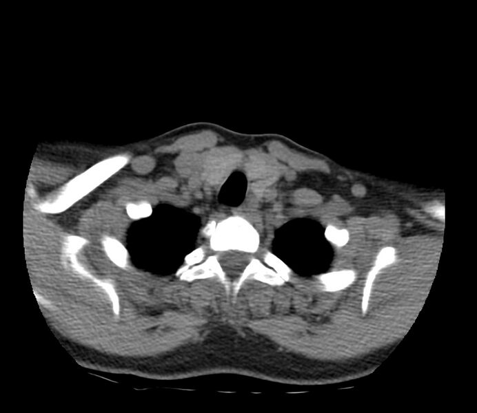 File:Cervical venous malformation (Radiopaedia 22653-22672 Axial non-contrast 48).jpg