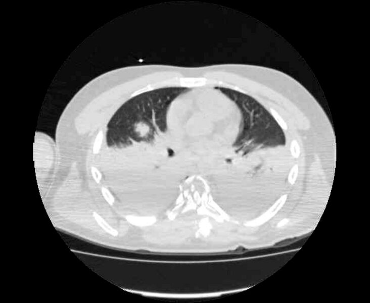 File:Chance fracture (Radiopaedia 38398-40475 Axial lung window 1).jpeg