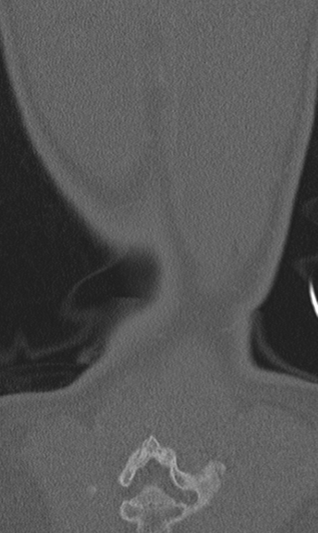 File:Chance fracture (Radiopaedia 40360-42912 Coronal bone window 70).png