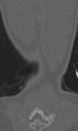 Chance fracture (Radiopaedia 40360-42912 Coronal bone window 70).png