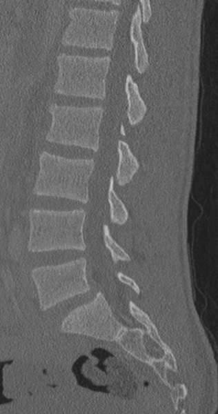 File:Chance fracture (Radiopaedia 40360-42912 Sagittal bone window 47).png