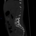 Chance fracture with duodenal and pancreatic lacerations (Radiopaedia 43477-50042 Sagittal bone window 19).jpg