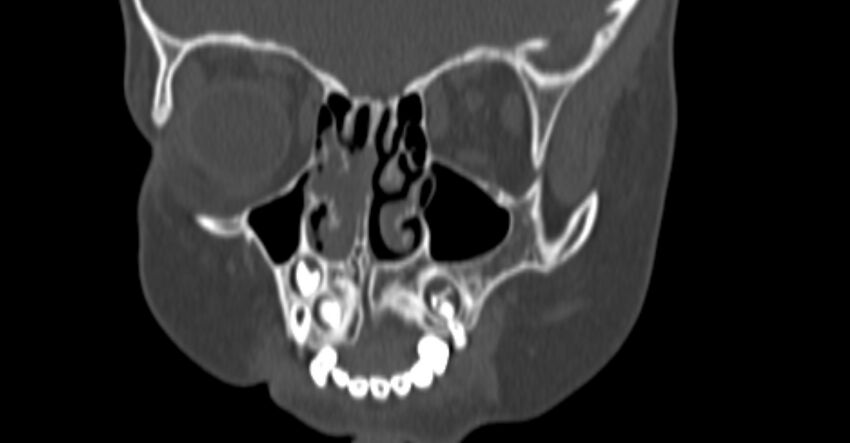 Choanal atresia (Radiopaedia 51295-56972 Coronal bone window 26).jpg
