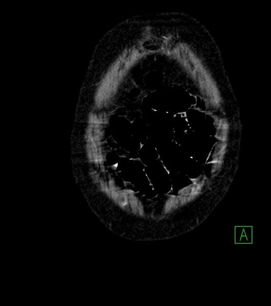 File:Cholangiocarcinoma with cerebral metastases (Radiopaedia 83519-98629 E 7).jpg