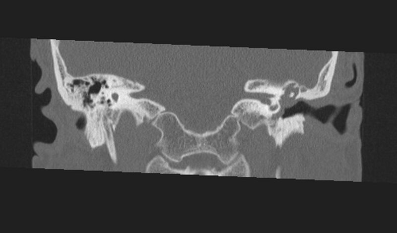 File:Cholesteatoma (Radiopaedia 10742-11203 Coronal bone window 13).jpg