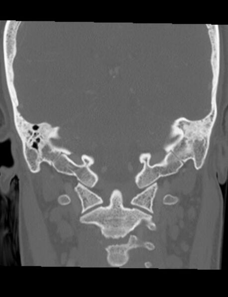 File:Cholesteatoma (pars flaccida) (Radiopaedia 28782-29083 Coronal bone window 6).jpg