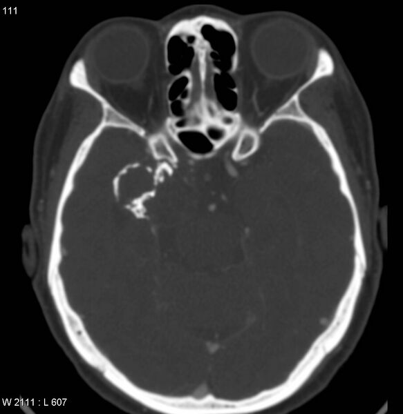 File:Chondrosarcoma - sphenoid wing (Radiopaedia 5421-7174 Axial bone window 6).jpg