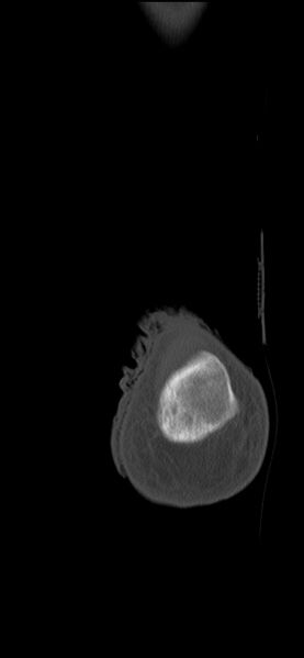 File:Chopart fracture (Radiopaedia 35347-36851 Coronal bone window 4).jpg