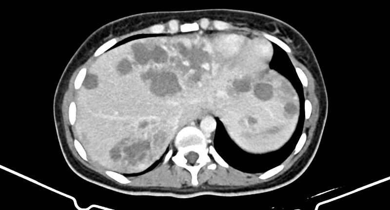 File:Choriocarcinoma liver metastases (Radiopaedia 74768-85766 A 35).jpg