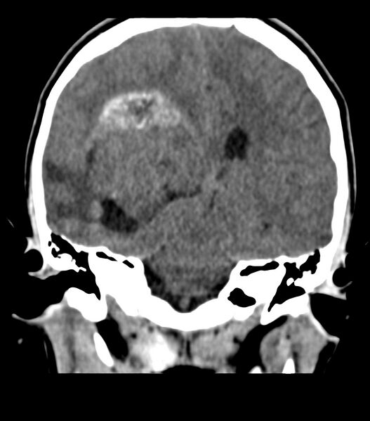 File:Choroid plexus carcinoma (Radiopaedia 91013-108552 Coronal non-contrast 49).jpg